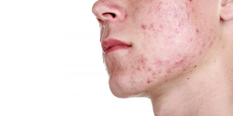 Tratamento de uns cosméticos de acne
